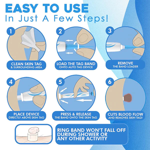 Skin-tag Remover (+GRATIS Bandenlader + 10 Bandjes + 10 puistjespleisters) - Verwijder Gemakkelijk, Snel en Pijnloos Skin-Tags