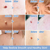 Afbeelding laden in Galerijviewer, Skin-tag Remover (+GRATIS Bandenlader + 10 Bandjes + 10 puistjespleisters) - Verwijder Gemakkelijk, Snel en Pijnloos Skin-Tags